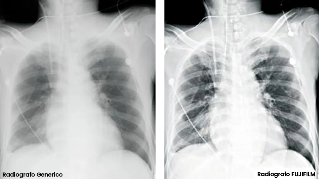 Confronto tra radiografia del torace con radiografo generico a sinistra e tecnologia FUJIFILM a destra